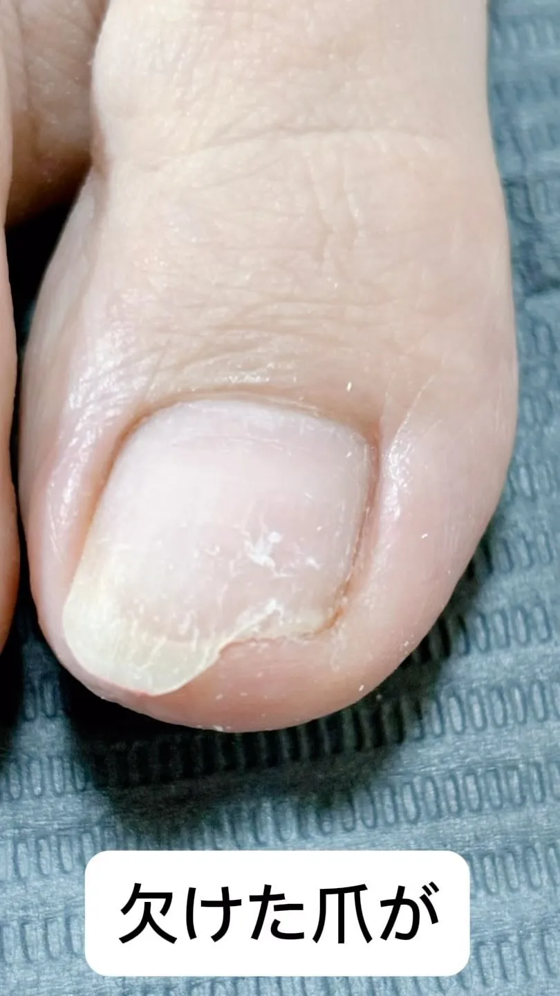 欠けた爪を修復✨
